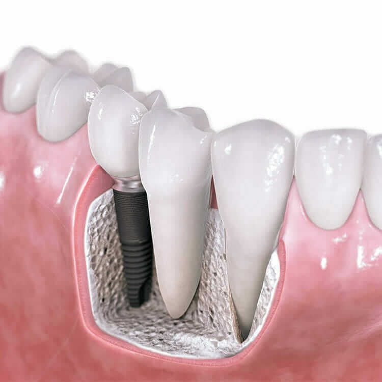 Oshawa Dental Implants