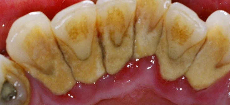 Periodontal-Disease