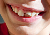 Mouthguards-help-prevent-broken-teeth