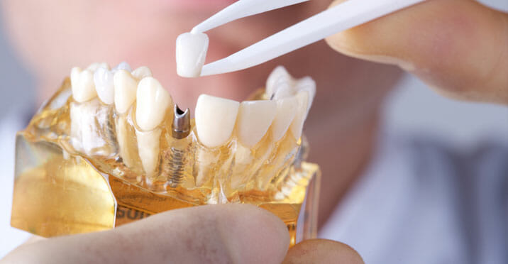 Dental Implants