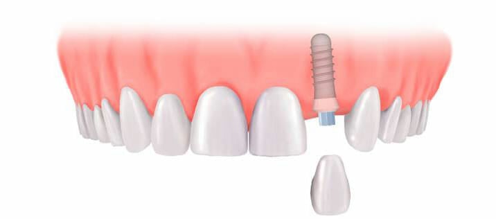 Dental-Implants