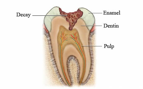 tooth-decay