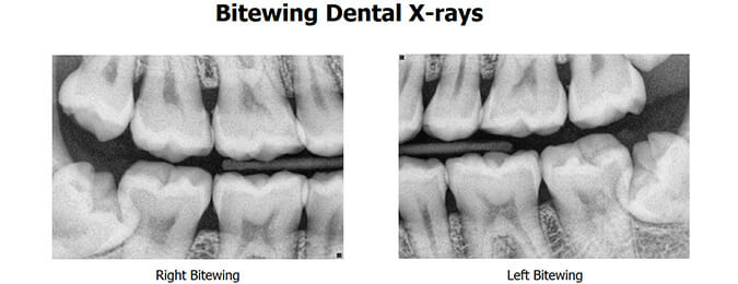 bitewing-x-rays-dental