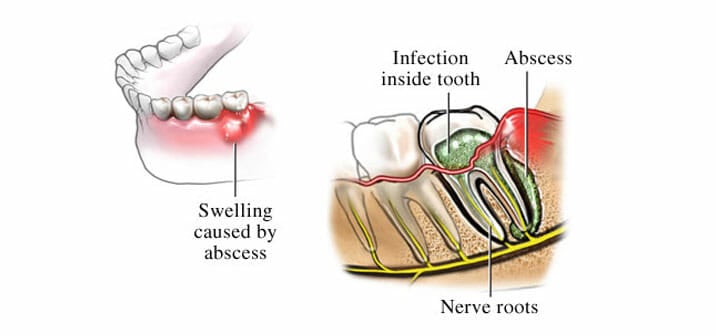 abscessed-tooth