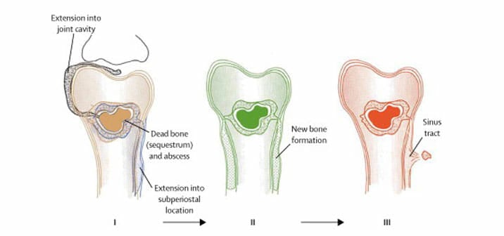 osteomyelitis