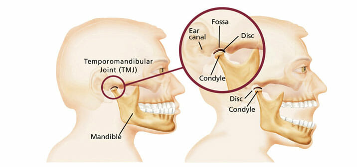 temporomandibular-disorder