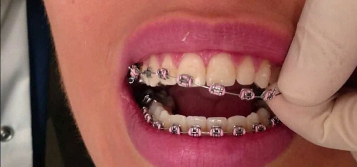 How to Remove Braces