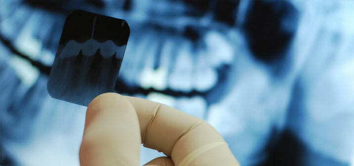 Dental-X-Rays