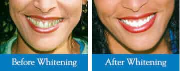 before and after teeth whitening oshawa