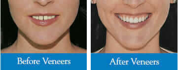 before and after veneers oshawa dentist