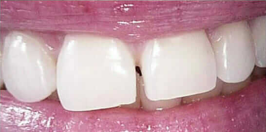 straight teeth