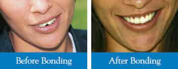 before and after teeth bonding oshawa