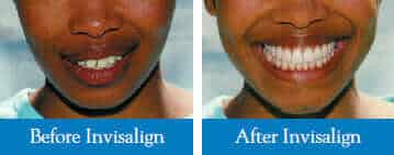 Before and After Success Invisalign photo