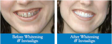 invisalign before and after teeth whitening oshawa