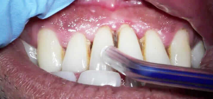 Tartar on Teeth