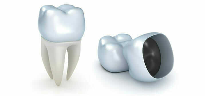 Dental Crowns