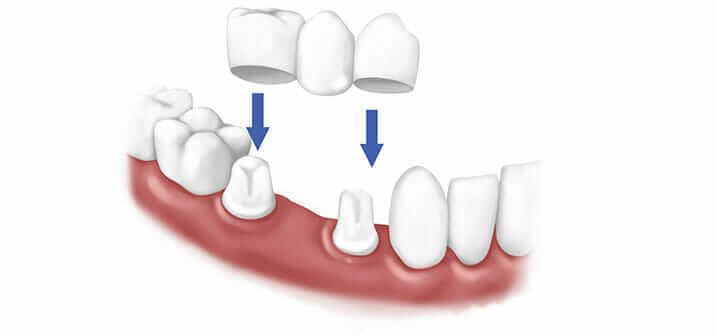 Dental bridges