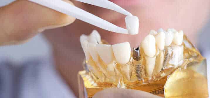 Dental implants