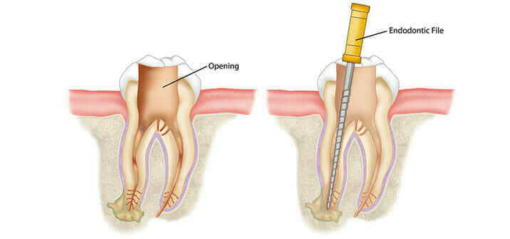 Root-canal