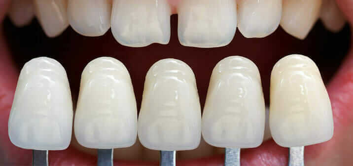 Dental Veneers