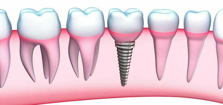 Dental implants