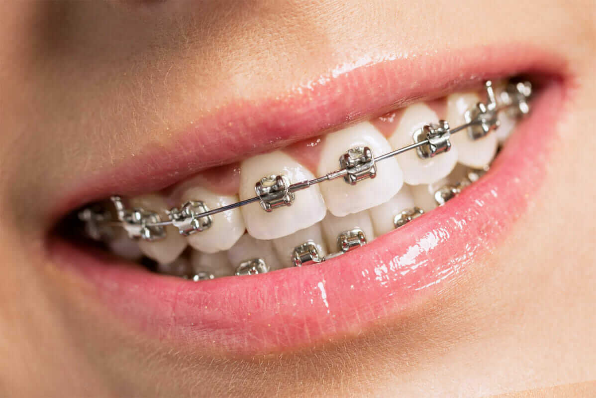 Achieve a straighter smile with traditional metal braces