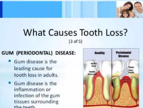 Tooth Loss