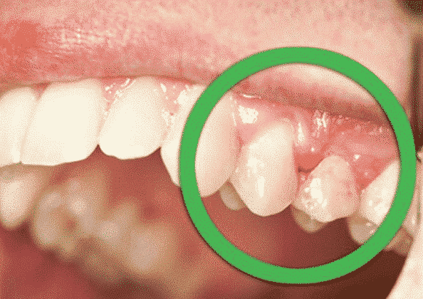 Signs of A Dead (Non Vital) Tooth