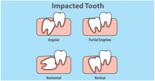 impacted tooth