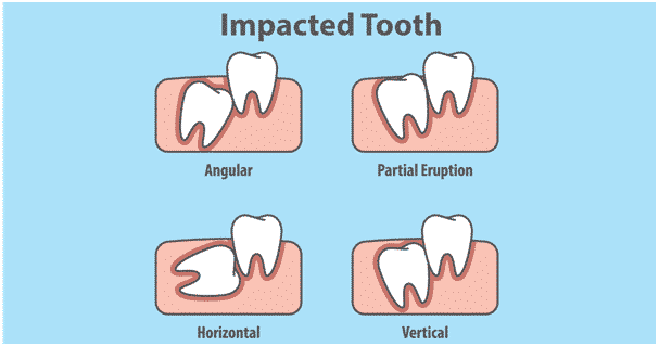 Impacted tooth