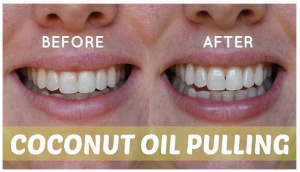 Coconut Oil Pulling