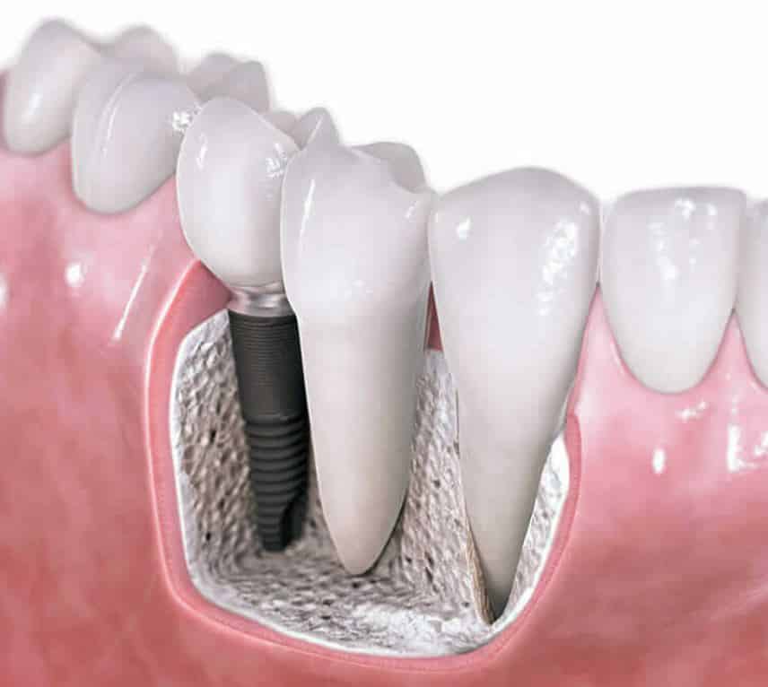 Teeth Implant