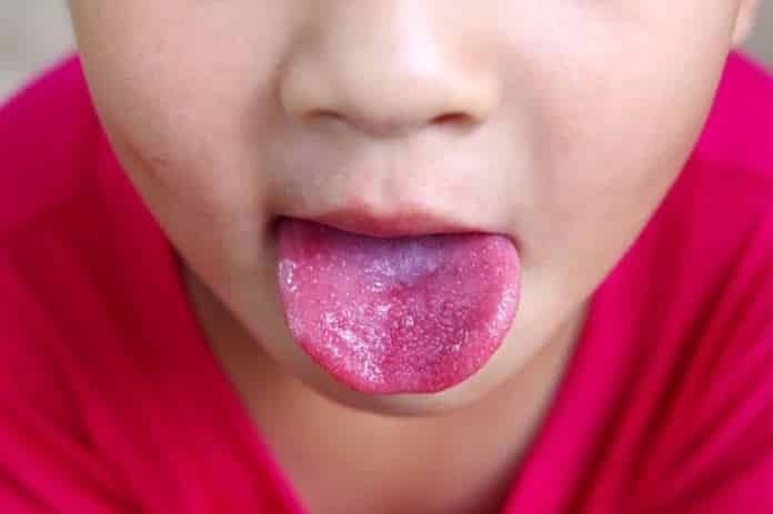 red tongue issues