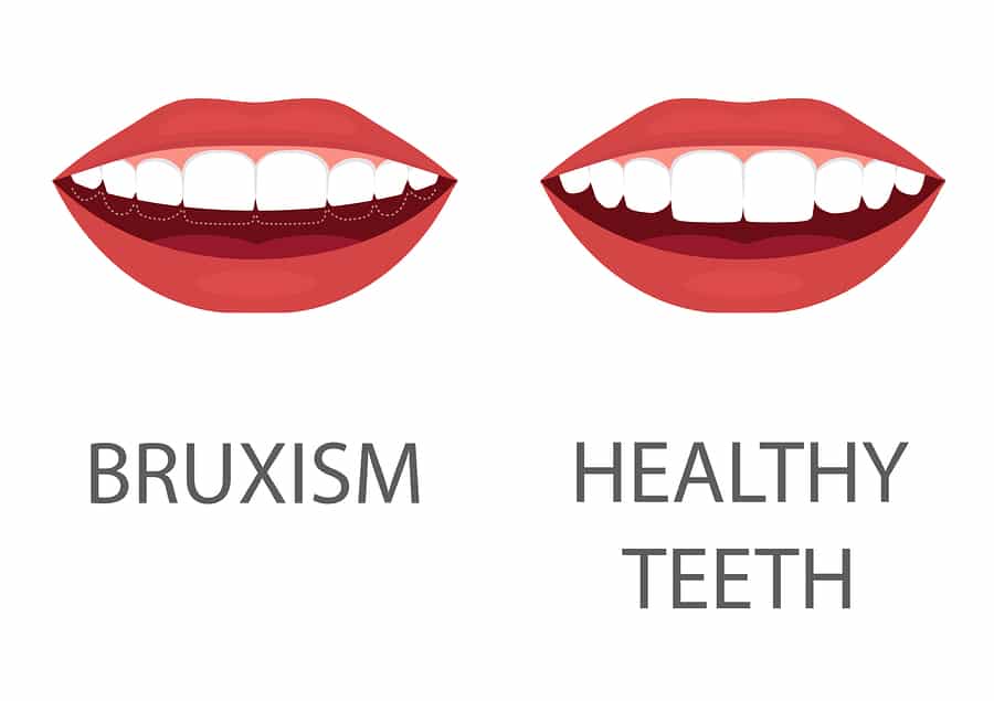 bruxism