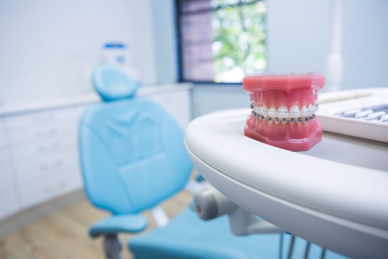 What Are All-on-4 Teeth Implants in Dentistry?