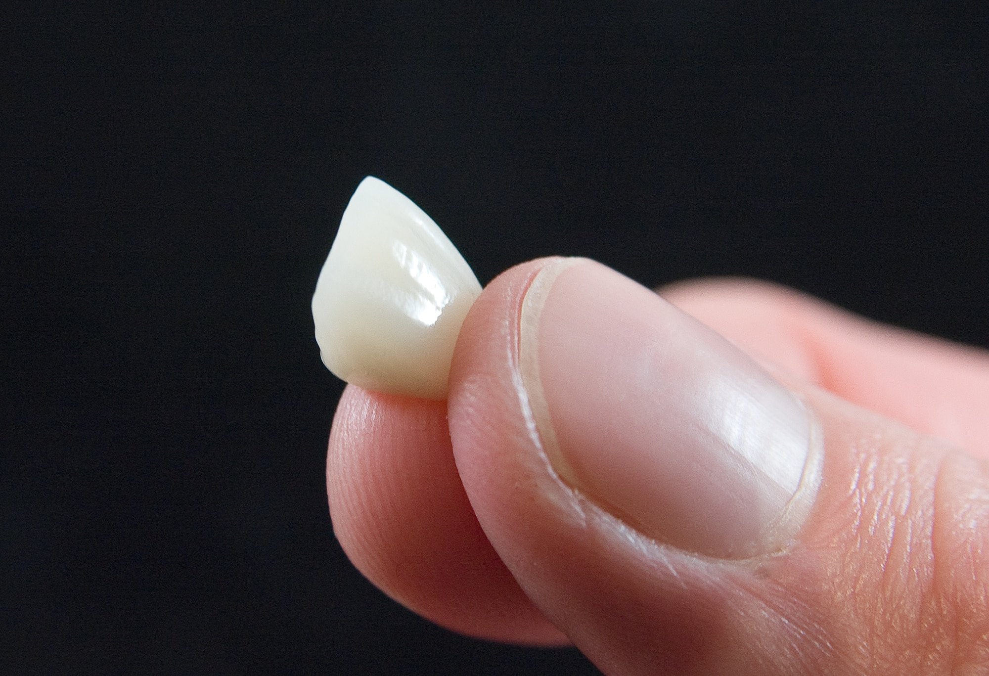 Cracked Teeth