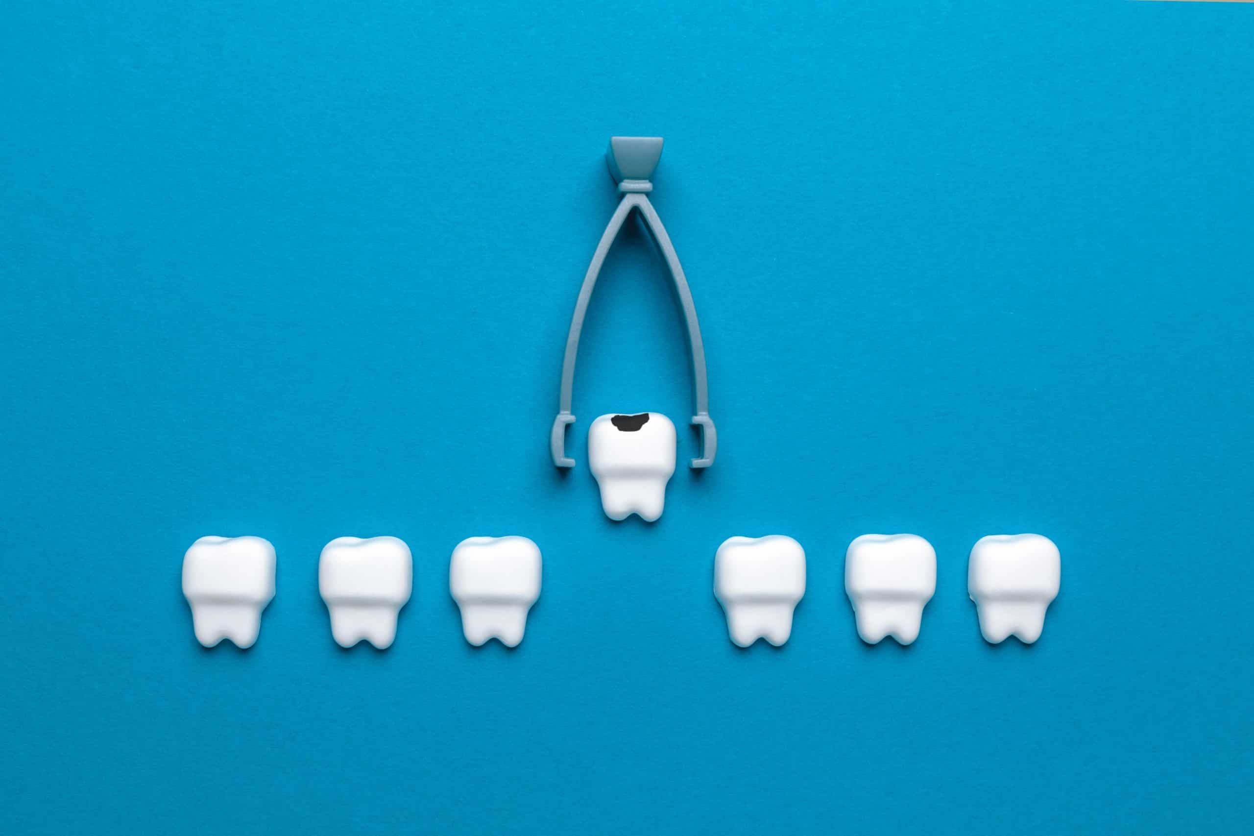 Wisdom Teeth Removal