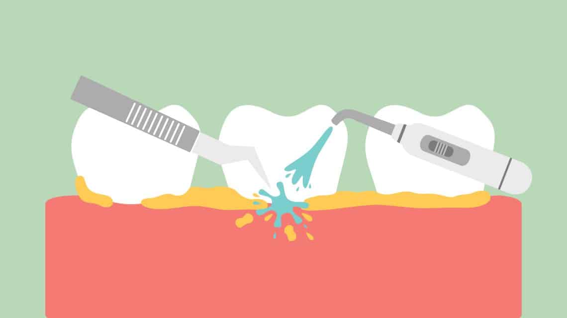 What Is Dental Scaling and Root Planning