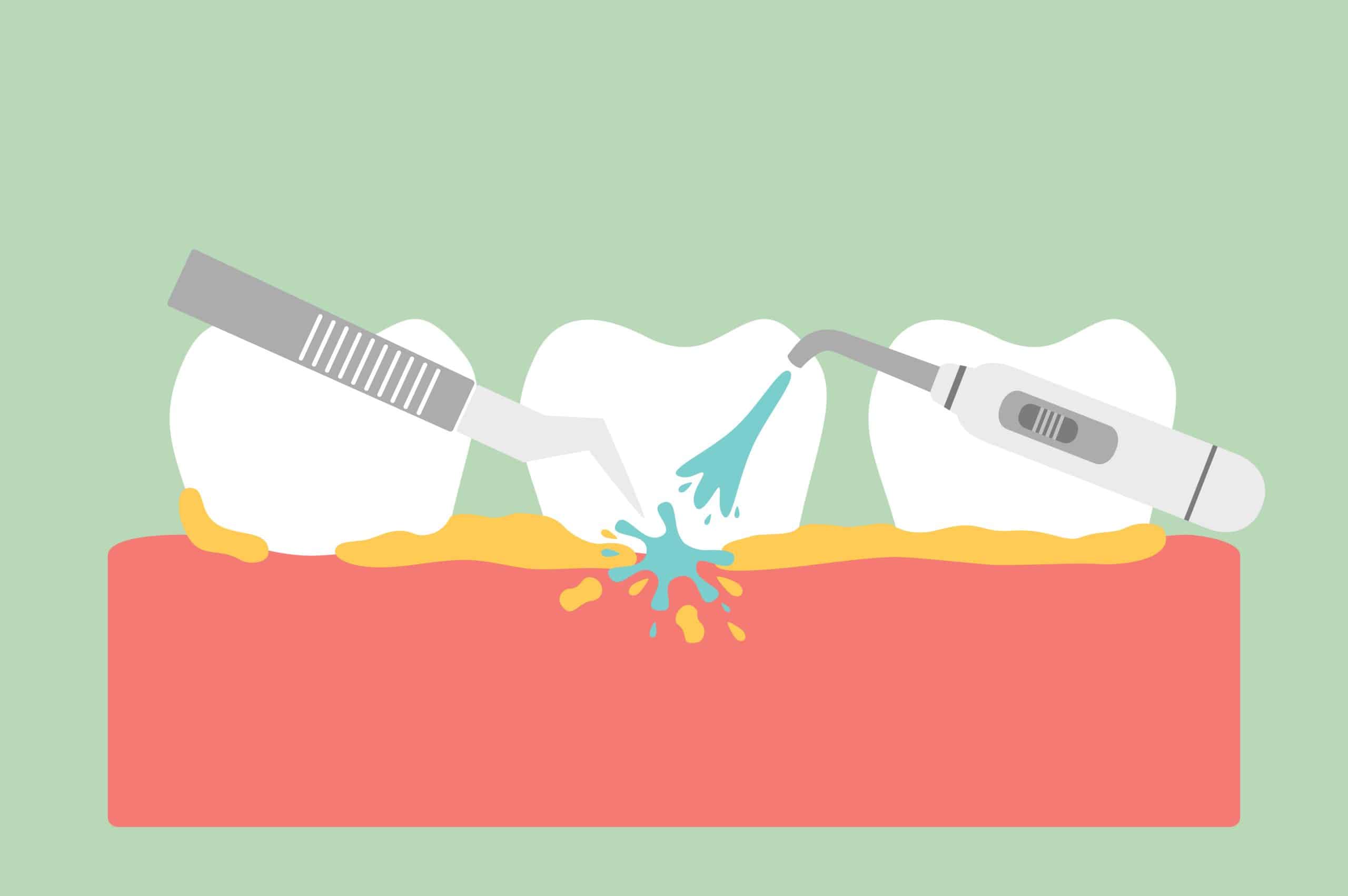 What Is Dental Scaling and Root Planning