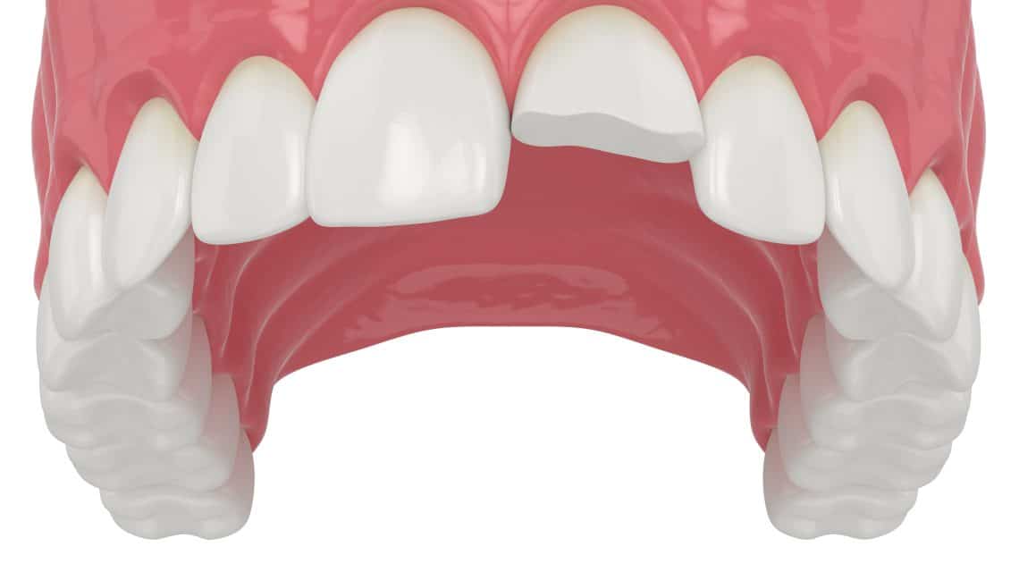 Can a Dentist Fix a Chipped Tooth