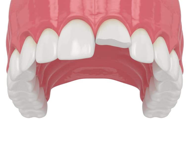 Can a Dentist Fix a Chipped Tooth?