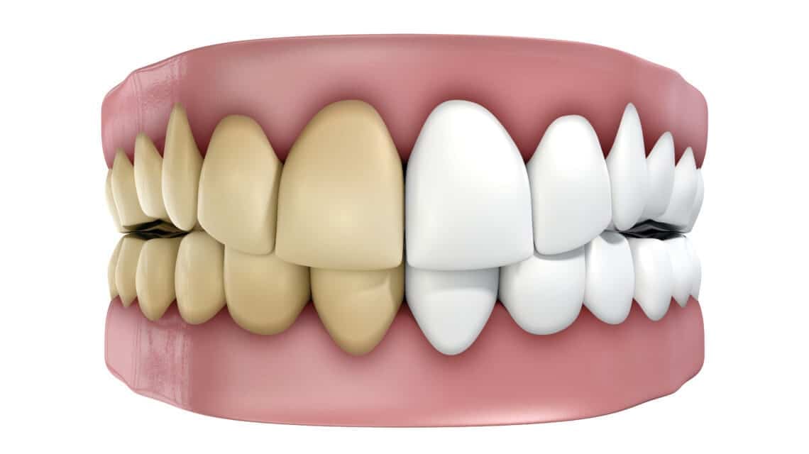 Can a dentist remove brown stains on teeth?