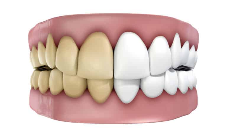 Can a dentist remove brown stains on teeth?