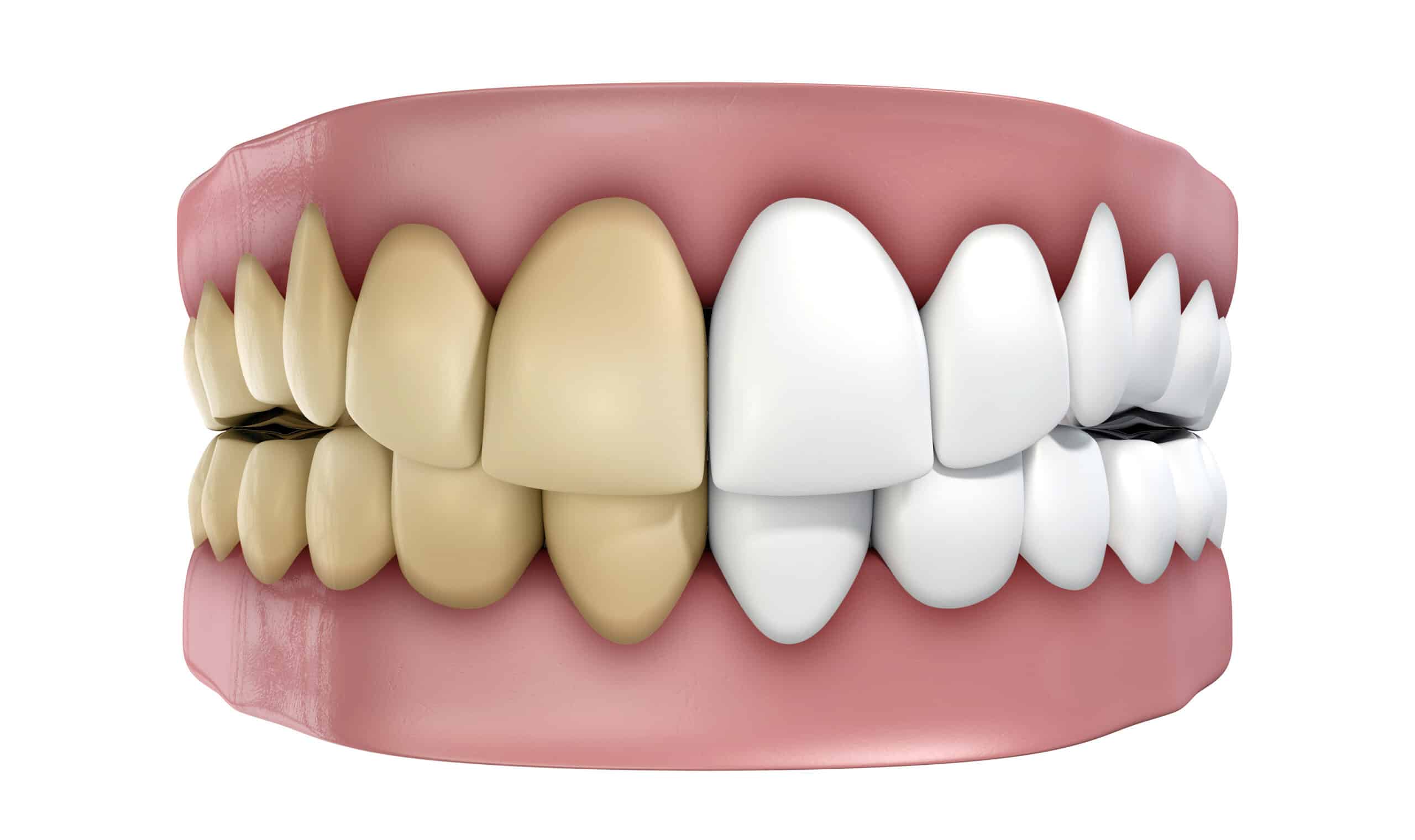 Can a dentist remove brown stains on teeth?