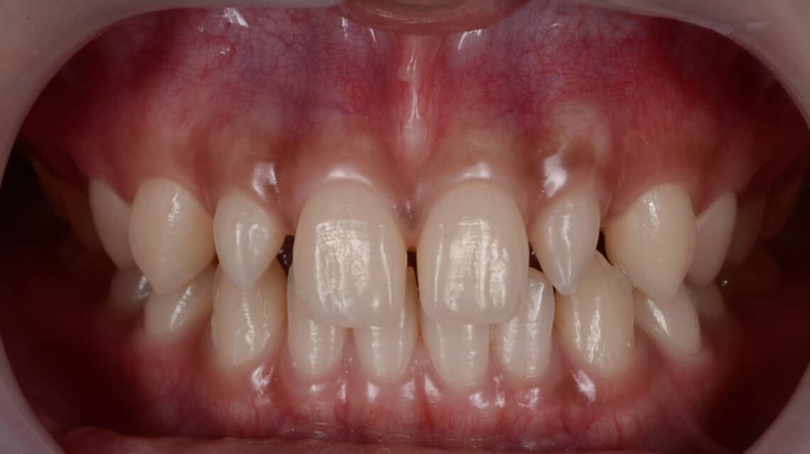 Treatment Options For Peg-Shaped Teeth