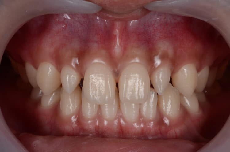 Treatment Options For Peg-Shaped Teeth