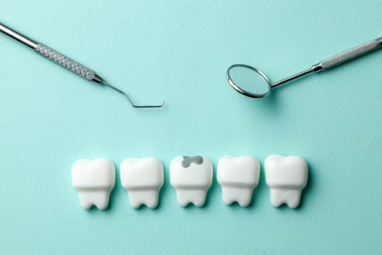 How Long Can a Cavity Go Untreated