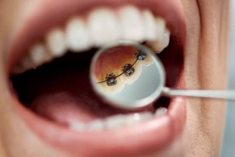 7 Things You Should Know About Lingual Braces