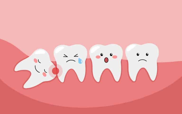What You Should Know About Wisdom Teeth